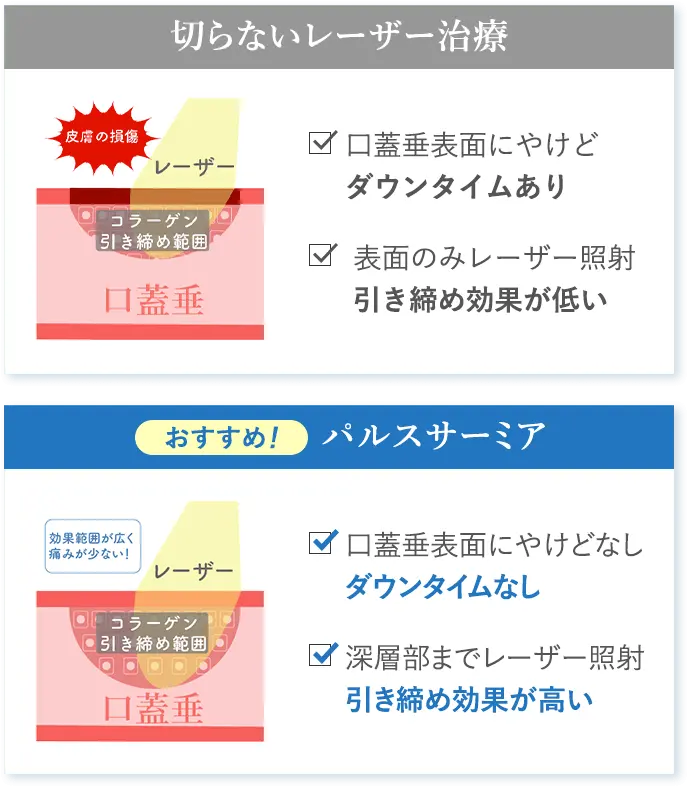 切らないレーザー治療とパルスサーミアの比較