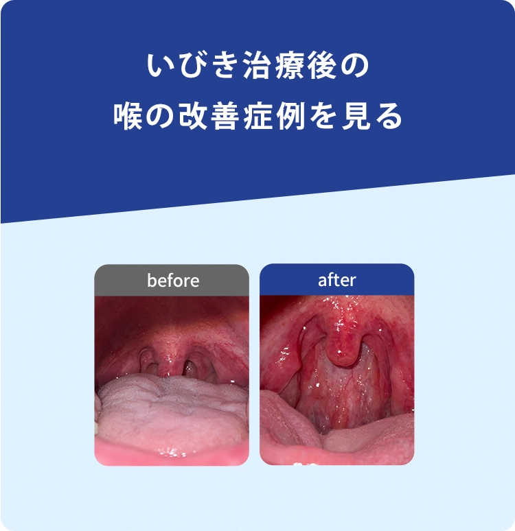 いびき治療後の患者様の声と喉の改善症例を見る