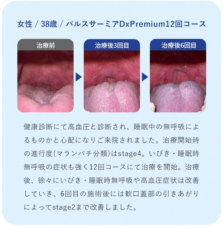 女性 / 38歳 / パルスサーミアDx Premium12回コース 健康診断にて高血圧と診断され、睡眠中の無呼吸によるものかと心配になりご来院されました。治療開始時の進行度(マランパチ分類)はstage4。いびき・睡眠時無呼吸の症状も強く12回コースにて治療を開始。治療後、徐々にいびき・睡眠時無呼吸や高血圧症状は改善していき、6回目の施術後には軟口蓋部の引きあがりによってstage2まで改善しました。