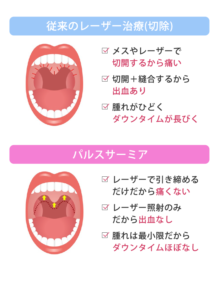 従来のレーザー治療(切除)　メスやレーザーで切開するから痛い　切開＋縫合するから出血あり　腫れがひどくダウンタイムが長びく　パルスサーミア　レーザーで引き締めるだけだから痛くない　レーザー照射のみから出血なし　腫れは最小限だからダウンタイムほぼなし